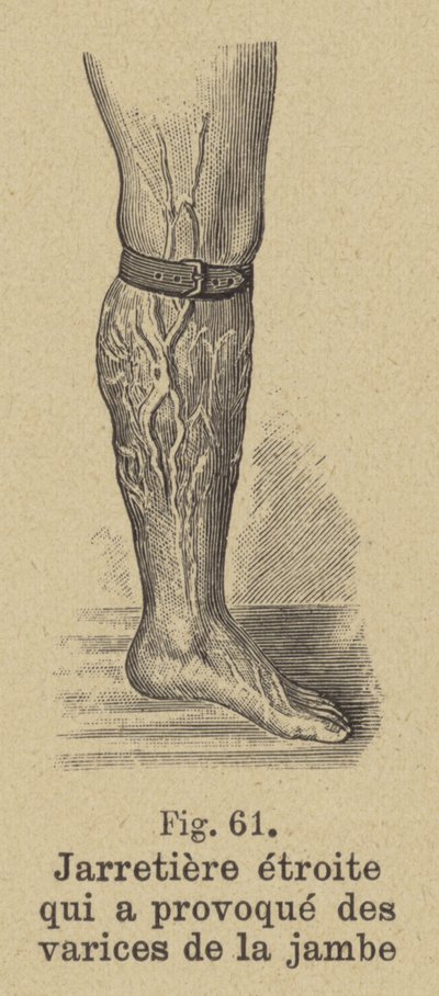 Stram strømpebånd, der forårsager åreknuder i benet af German School